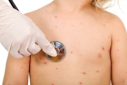 Morbillo, a Catania torna l'allarme: otto casi in dieci giorni