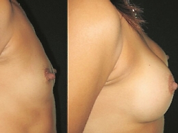 Rimodellamento seno: protesi o tessuto adiposo?