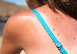 La nuova molecola che potrebbe cambiare la cura del melanoma prima dell&rsquo;intervento